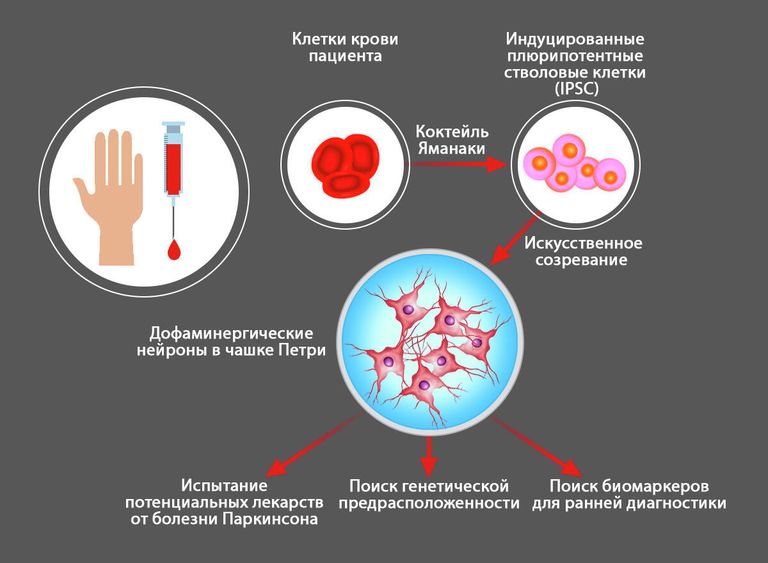 Выращивание нейронов из клеток пациента с болезнью Паркинсона
