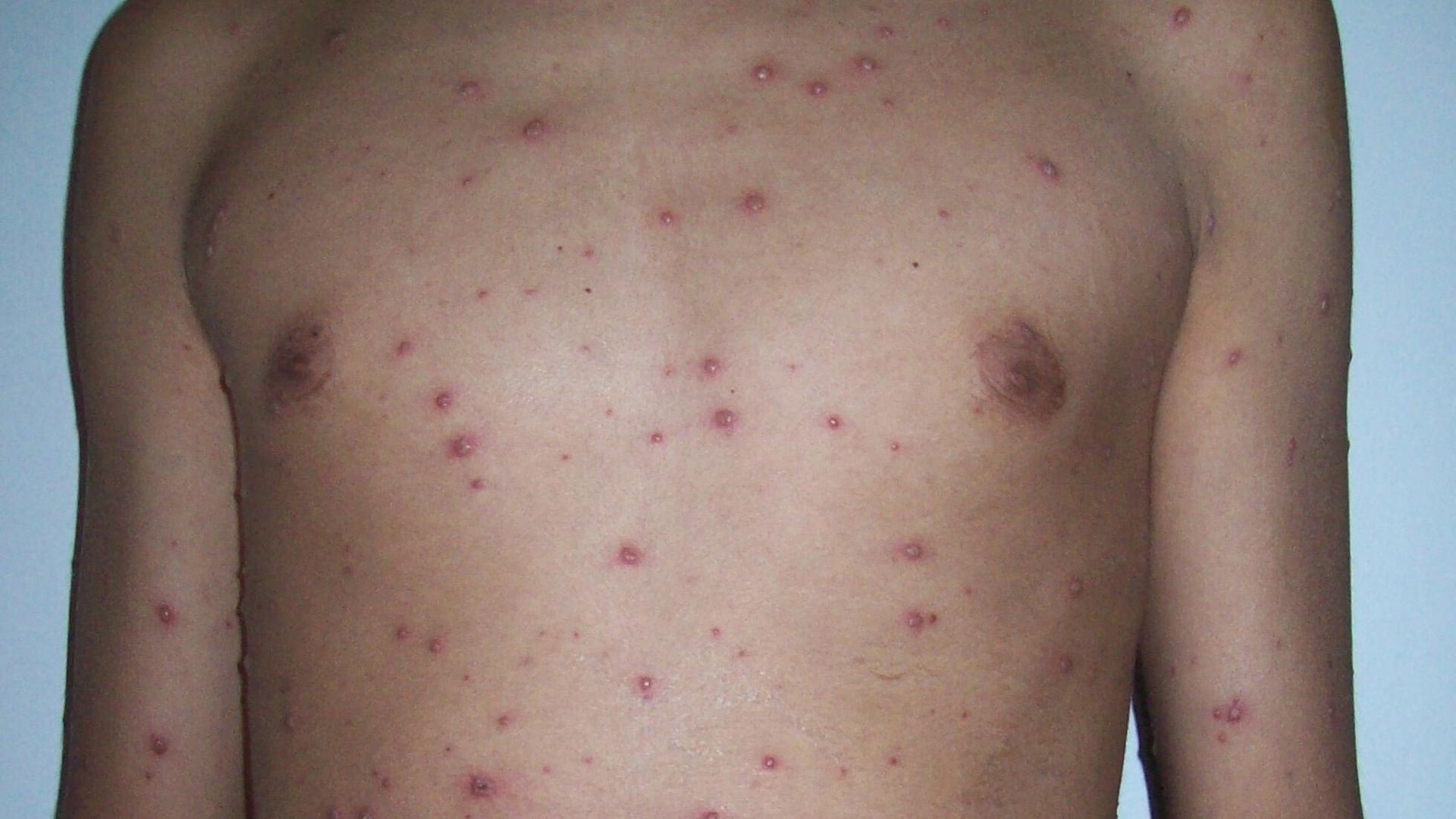 Вариант сыпи при ветряной оспе Вариант сыпи при ветряной оспе - РИА Новости, 1920, 19.07.2022