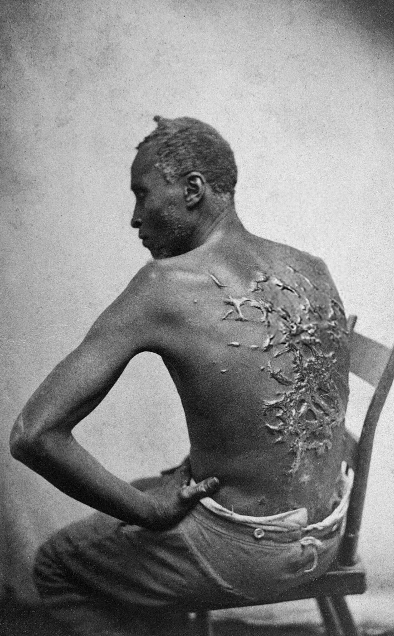 Американский раб с тяжелыми келоидными шрамами. 1863 Американский раб с тяжелыми келоидными шрамами. 1863 - РИА Новости, 1920, 07.12.2021