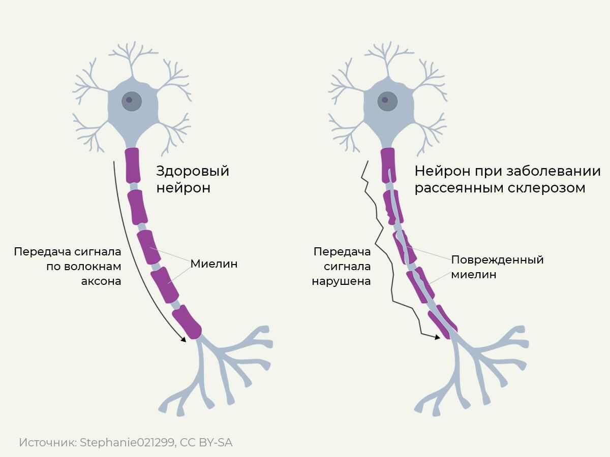 Поражение нервных клеток при рассеянном склерозе Поражение нервных клеток при рассеянном склерозе - РИА Новости, 1920, 02.02.2023