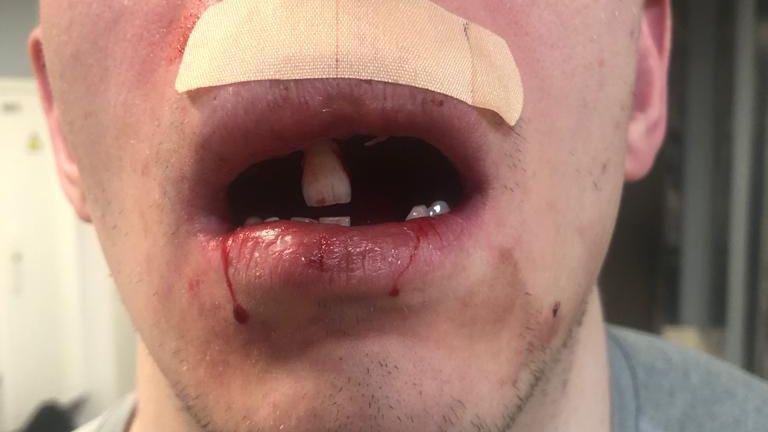 Лишившийся зубов хоккеист СКА Зыков Лишившийся зубов хоккеист СКА Зыков - РИА Новости, 1920, 07.02.2023