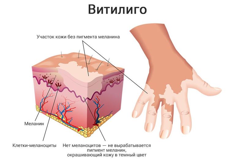 Механизм возникновения витилиго Механизм возникновения витилиго
