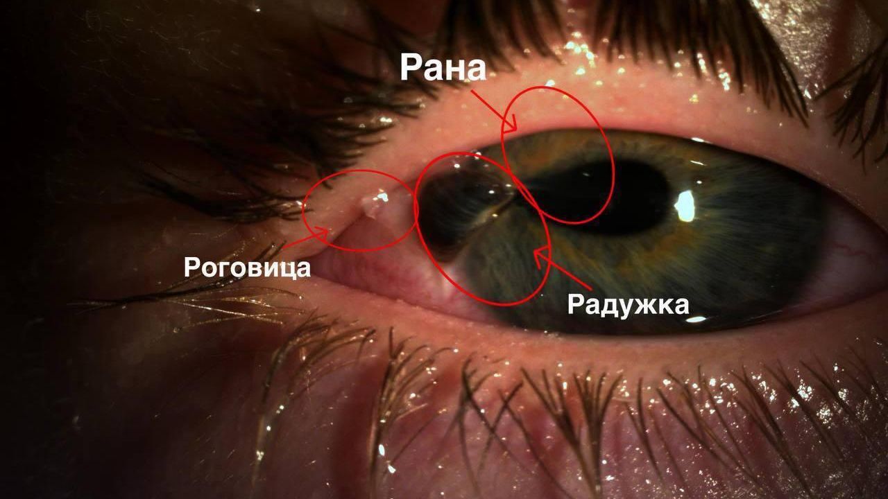 Врачи Детского клинического центра имени Л. М. Рошаля спасли зрение 10-летнему мальчику, в глаз которого попали осколки стекла Врачи Детского клинического центра имени Л. М. Рошаля спасли зрение 10-летнему мальчику, в глаз которого попали осколки стекла - РИА Новости, 1920, 14.04.2025