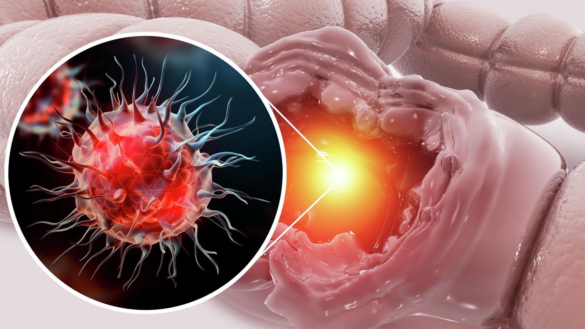 Раковые клетки в прямой кишке Раковые клетки в прямой кишке - РИА Новости, 1920, 05.02.2026