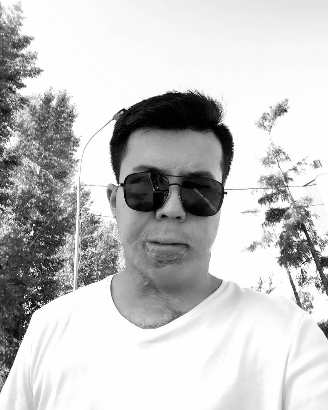Мирлану пересаживали не только его кожу, но и донорский материал о отца Мирлану пересаживали не только его кожу, но и донорский материал о отца - РИА Новости, 1920, 05.03.2026