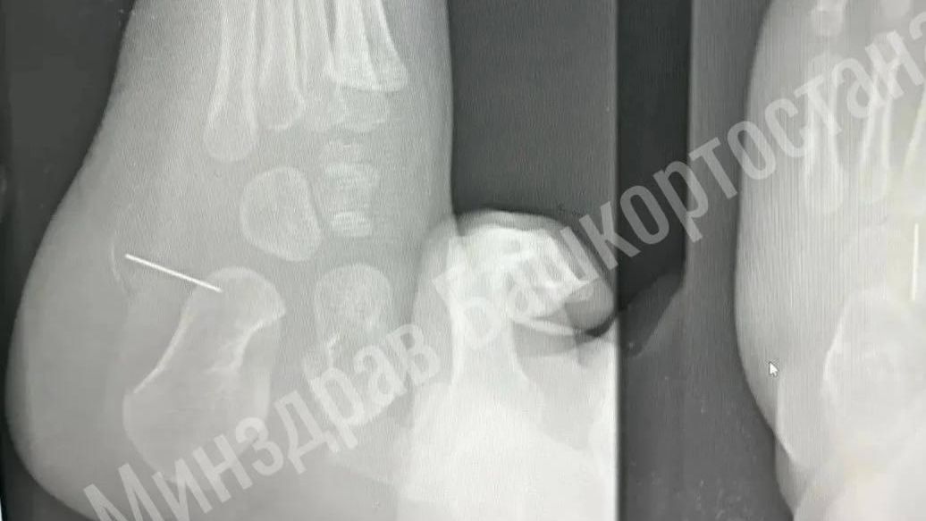 Врачи из башкирского Ишимбая извлекли 2-сантиметровую иглу из стопы полуторагодовалого ребенка - РИА Новости, 1920, 16.06.2026