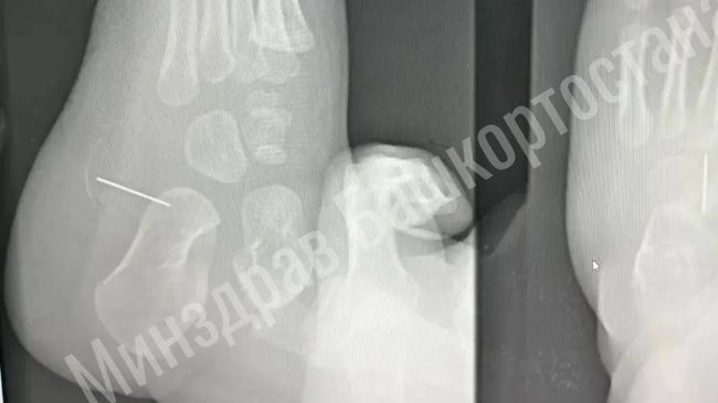 Врачи из башкирского Ишимбая извлекли 2-сантиметровую иглу из стопы полуторагодовалого ребенка