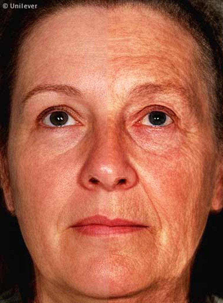 Слева – половина лица 49-летней женщины, справа – лицо 70-летней дамы Слева – половина лица 49-летней женщины, справа – лицо 70-летней дамы