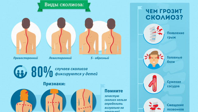 сколиоз
