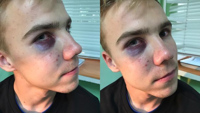 Владимир Сидоров после избиения Владимир Сидоров после избиения