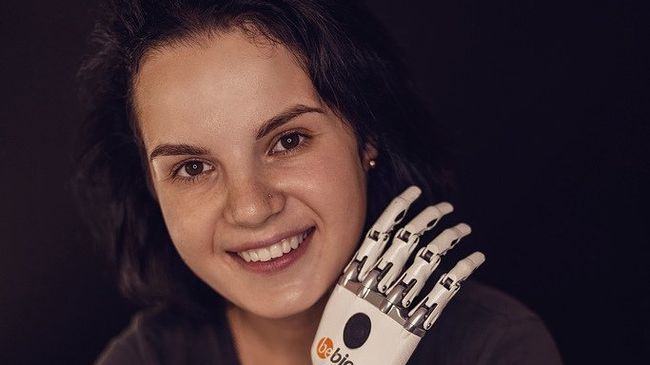 Пострадавшая Маргарита Грачева с бионическим протезом вместо руки Пострадавшая Маргарита Грачева с бионическим протезом вместо руки