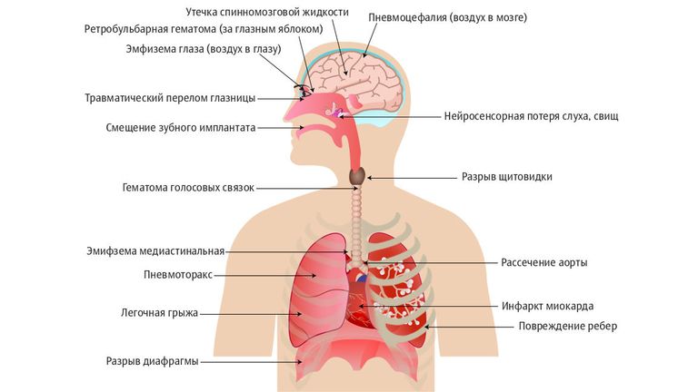 Повреждения, вызванные чиханием