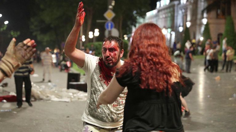 Мужчина, пострадавший во время акции протеста у здания парламента Грузии в Тбилиси Мужчина, пострадавший во время акции протеста у здания парламента Грузии в Тбилиси