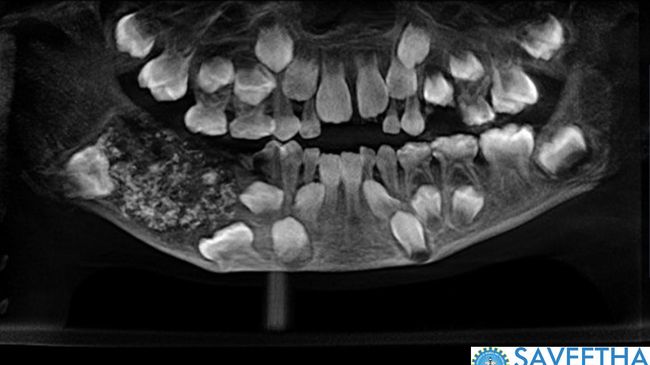 Зубы во рту 7 летнего мальчика из Индии, пациента Saveetha Dental College and Hospital Зубы во рту 7 летнего мальчика из Индии, пациента Saveetha Dental College and Hospital