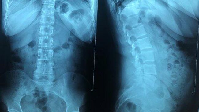 Эндоскопическое удаление грыжи межпозвонкового диска в нейрохирургическом центре ГВКГ имени акад. Н.Н.Бурденко