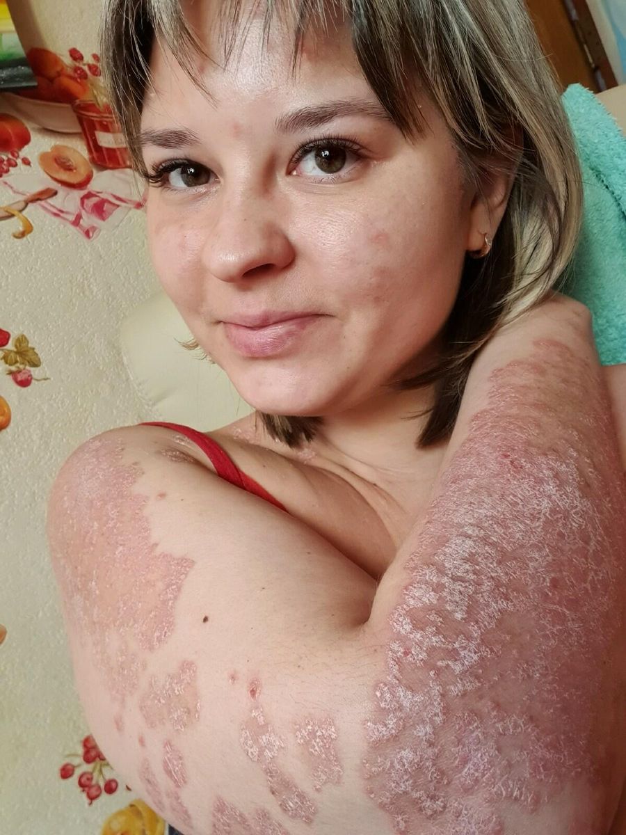 У Александры Ситдековой псориазом поражено 80 процентов кожных покровов