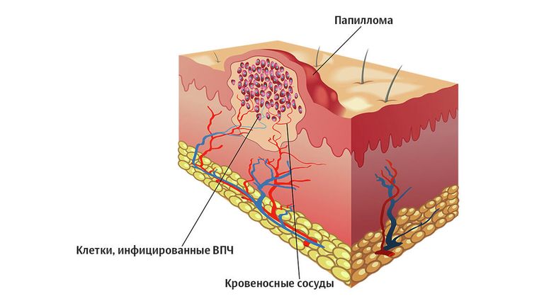 Вирус папилломы человека Вирус папилломы человека
