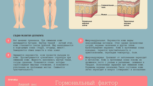 Что такое целлюлит и как с ним бороться