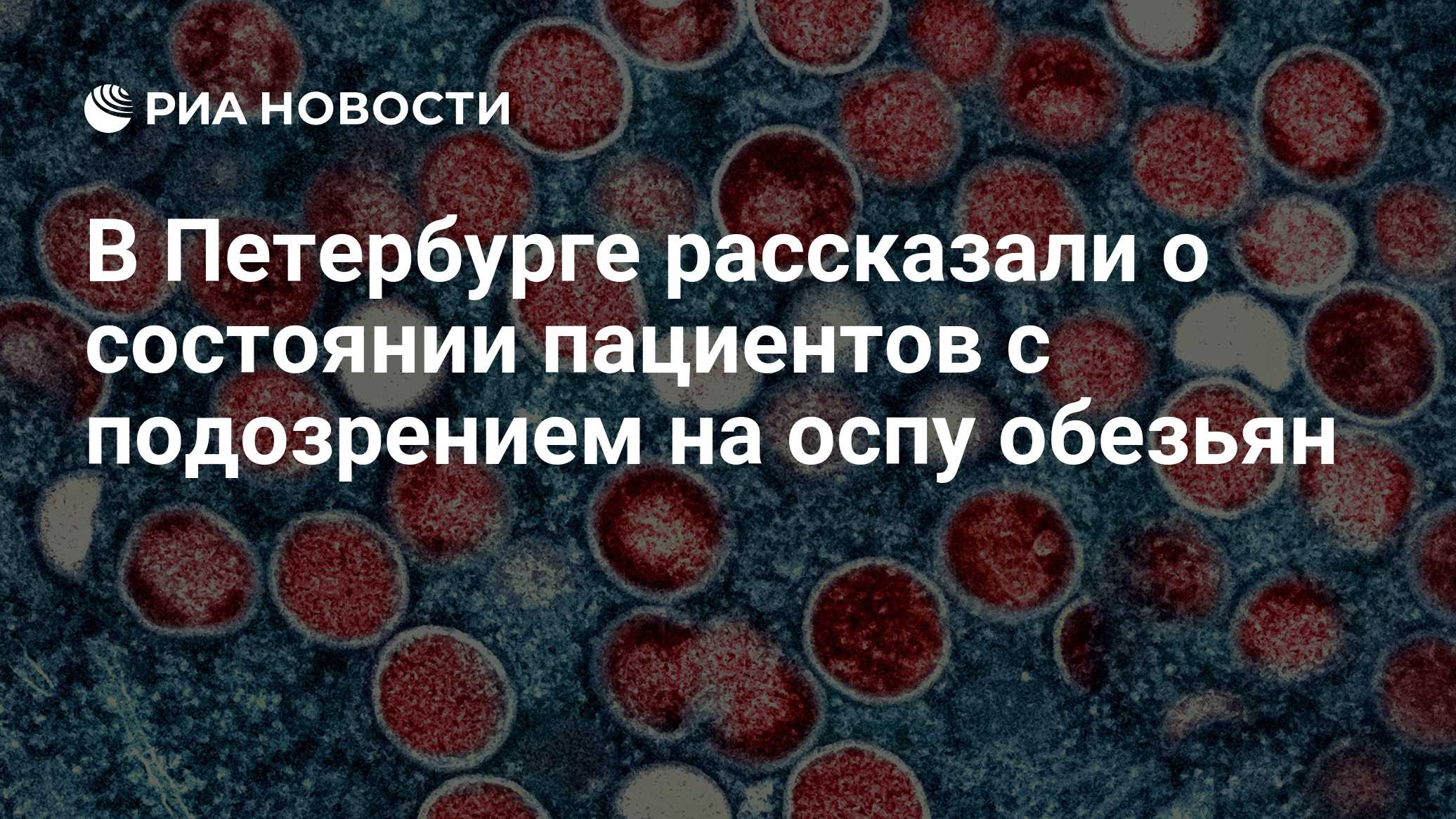 В Петербурге рассказали о состоянии пациентов с подозрением на оспу обезьян