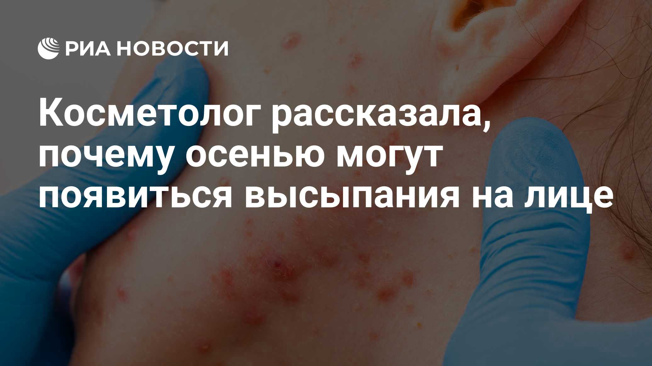 Косметолог рассказала, почему осенью могут появиться высыпания на лице