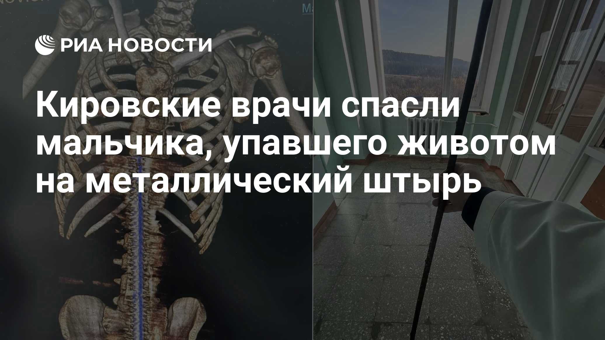 Кировские врачи спасли мальчика, упавшего животом на металлический штырь